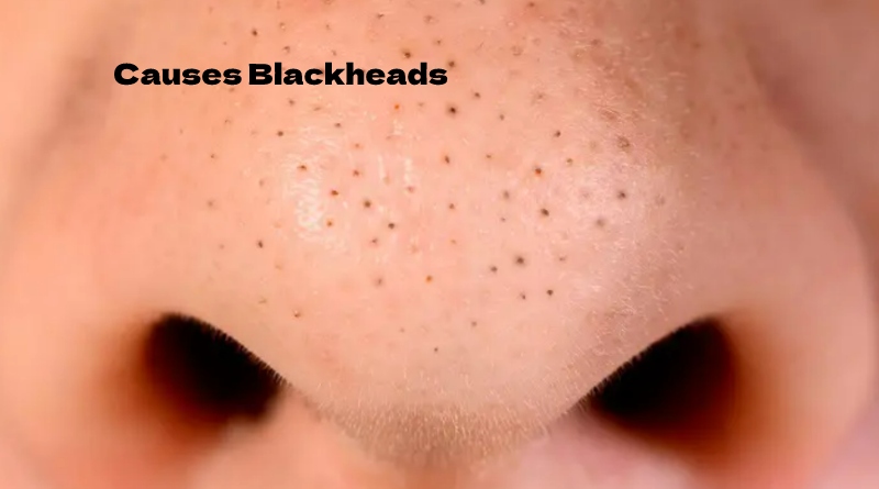 What Causes Blackheads On The Face