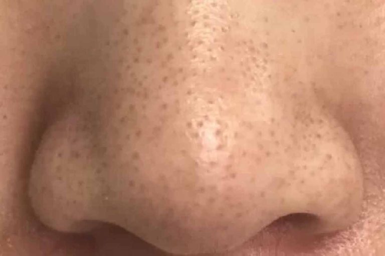 Blackheads – Clarifies Major Doubts Through Dermatologist