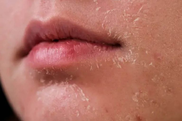 Dry Skin: Know Characteristics And What Care Should Take