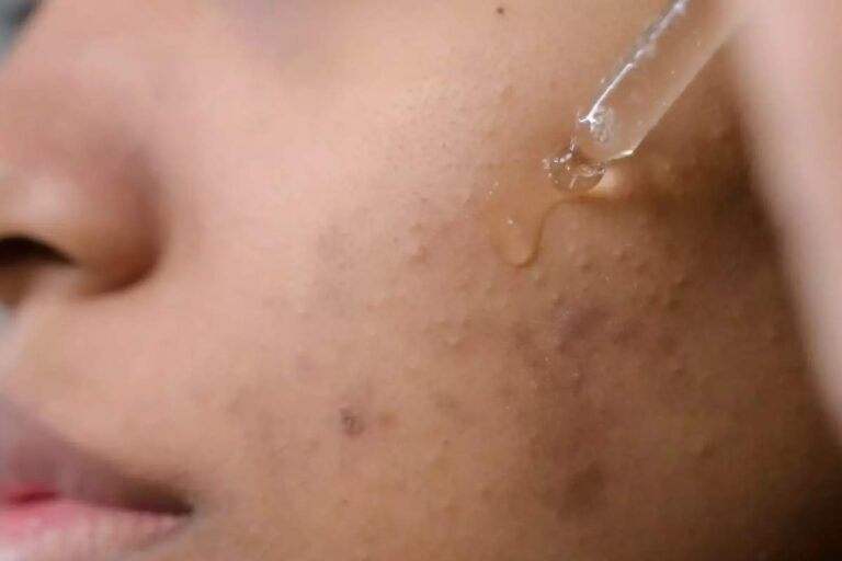 Prevent Post Inflammatory Hyperpigmentation(PIH)