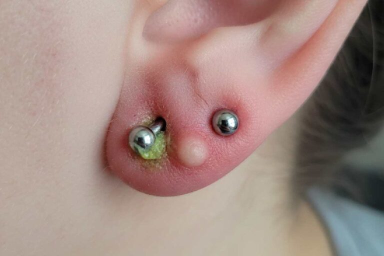 Infected Ear Piercing: Symptoms, Causes, Treatment and Prevention